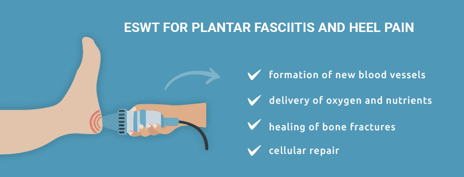 Shockwave Therapy For Plantar Fasciitis Thrive Now Physiotherapy