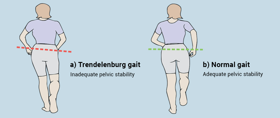 a) Normal pelvic support and (b) weakened pelvic support. Source