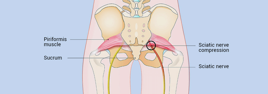 What Exactly is Sciatica?