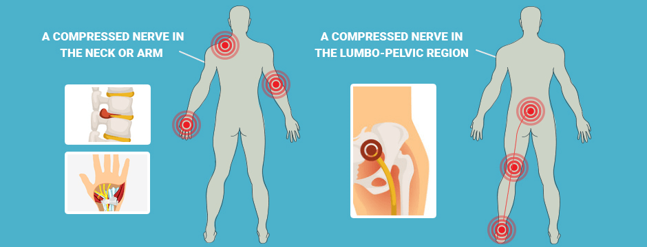 Pinched Nerve Pain Treatment South Florida