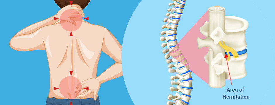 Low Back Pain and/or Nerve Impingement - Structura Body Therapies