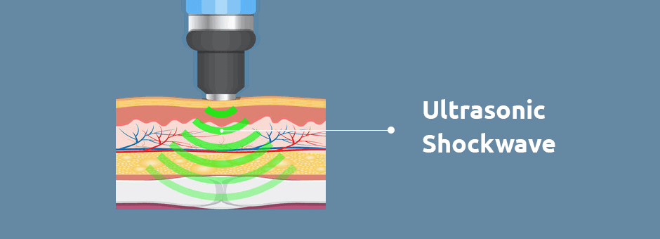 How Shockwave Therapy Works