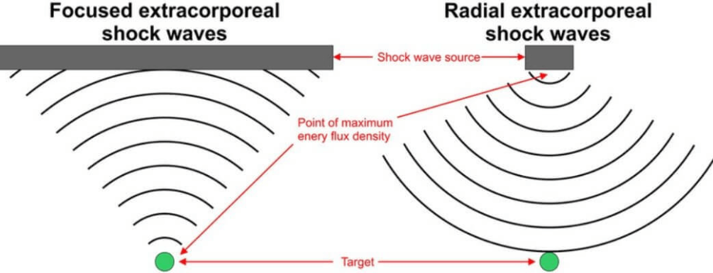 Radial vs Focused Shockwave