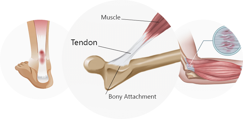 Types of Tendon Injuries