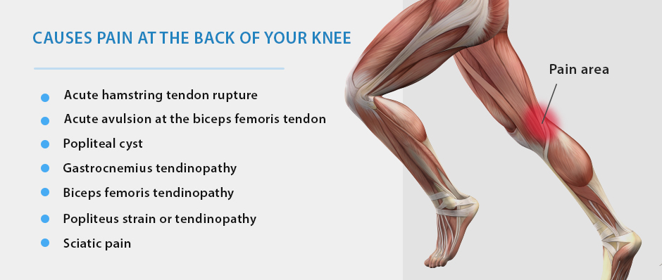  Posterior Knee Pain