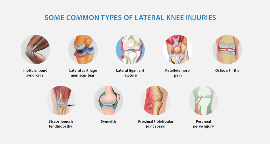 Lateral Knee Pain