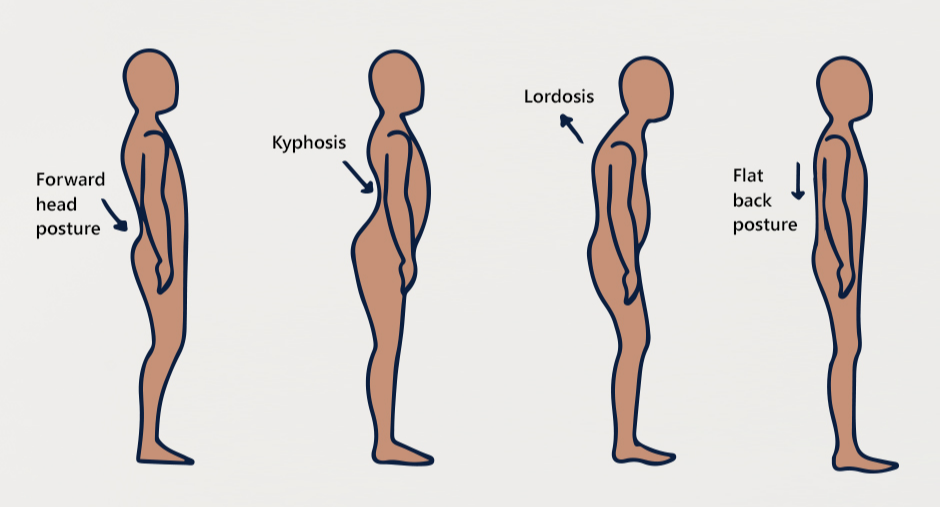 Common Postural Deviations