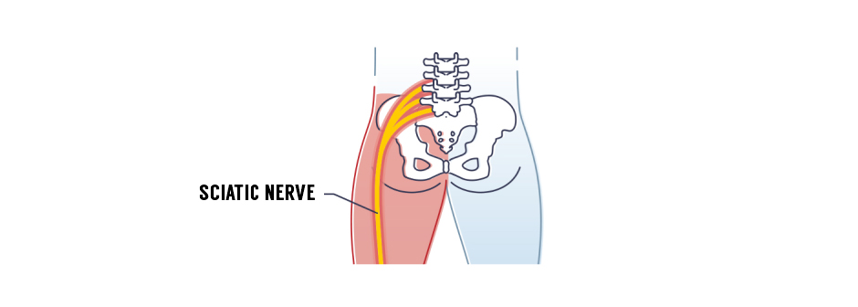 Your sciatic nerve is entrapped