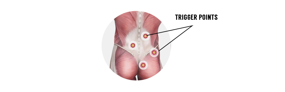 You have myofascial trigger points in your low back