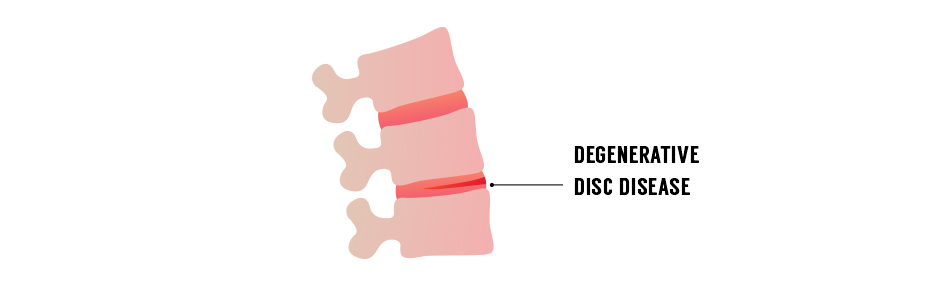 You have degenerative disc disease