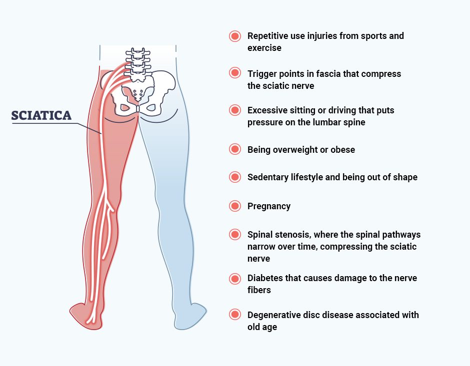 What Causes Sciatic Nerve Pain?