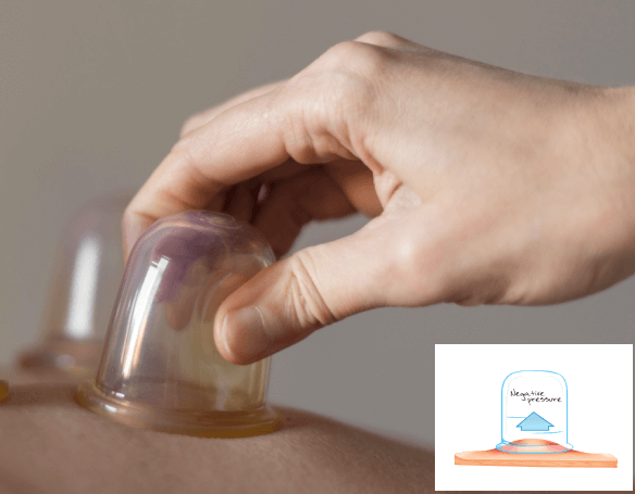 Pneumatic Cupping Therapy