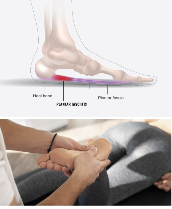 Get the Best Plantar Fasciitis Rehab that Really Works