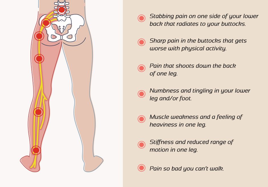 Sciatica Signs and Symptoms