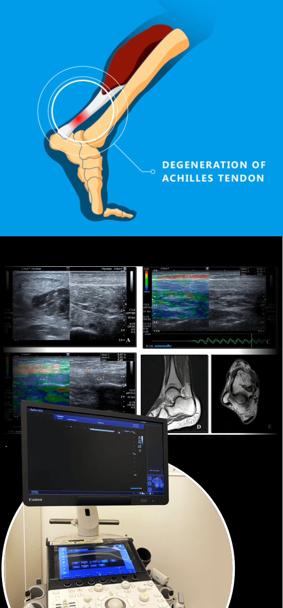 Advanced Diagnostics are Key to Successful Achilles Tendinitis Treatment