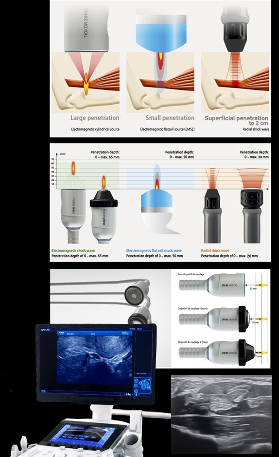  Focused Ultrasound-Guided Shockwave Therapy