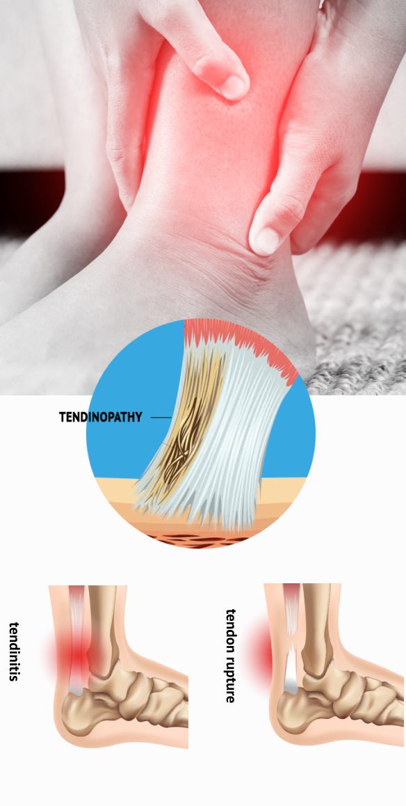 The most common types of tendon injuries include