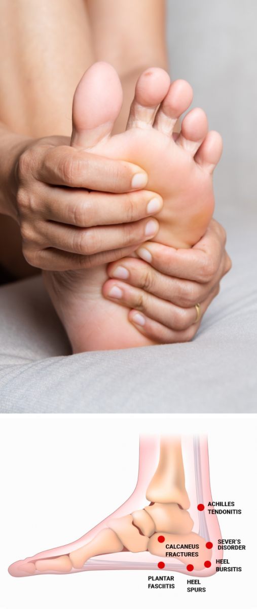 The most common types of heel pain