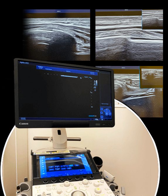  We Take Middle Back Pain Diagnosis to the Next Level with High-Resolution Ultrasound Imaging