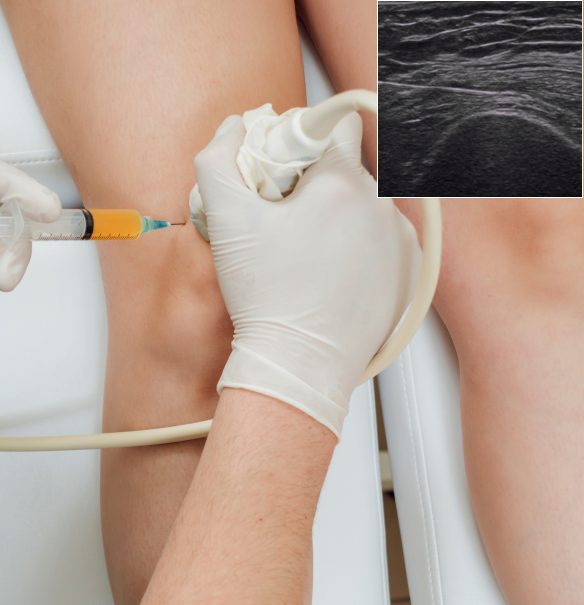 Ultrasound Guidance is a Game-Changer