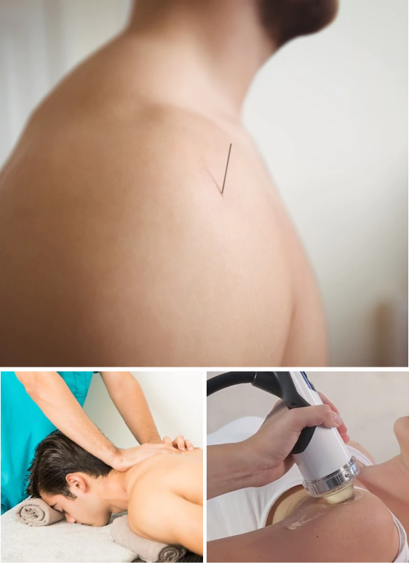 Shoulder Dry Needling as an Alternative to Shoulder Surgery