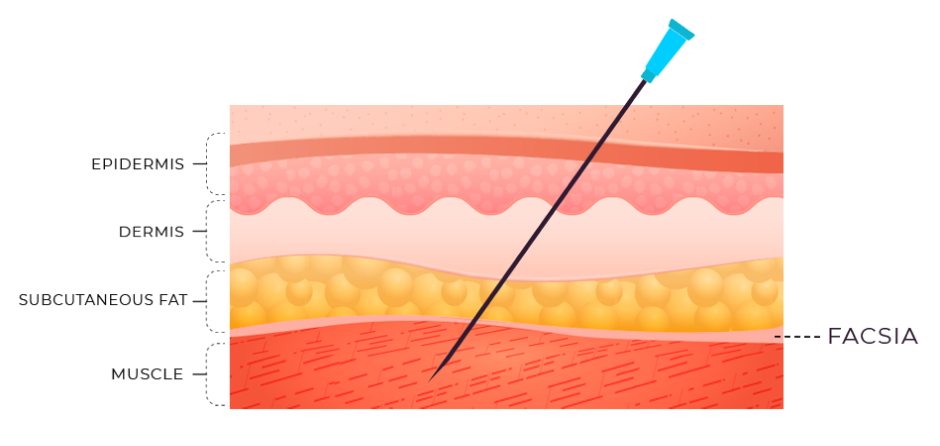 Fu’s Subcutaneous Needling for Back Pain
