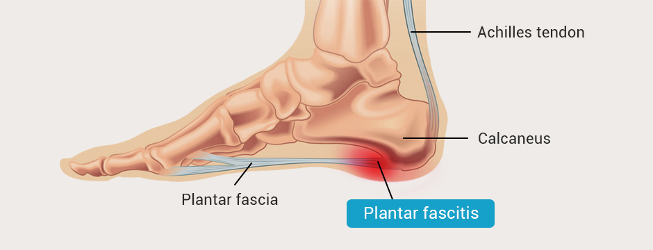 Plantar fasciitis symptoms include