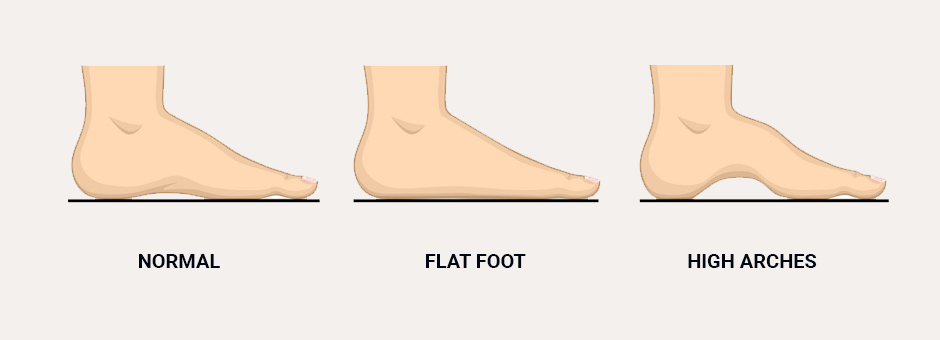 Factors Contributing to Plantar Fasciitis