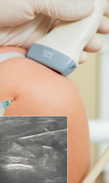 Ultrasound Guided Dry Needling
