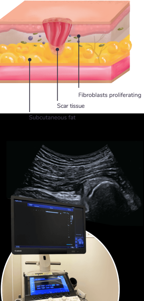 We Use High Resolution Ultrasound to Diagnose Scar Tissue Fibrosis and Adhesions