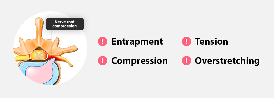 What Causes Nerves to Become Pinched or Entrapped?