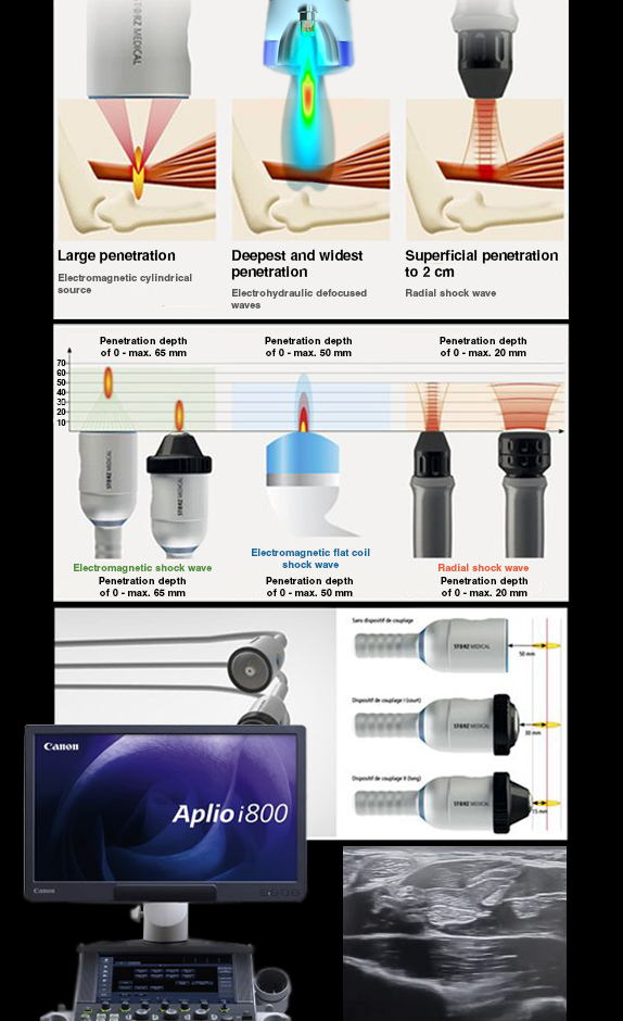  Focused Ultrasound-Guided Shockwave Therapy