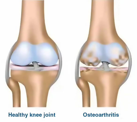 𝕄𝕦𝕤𝕔𝕝𝕖 & 𝕁𝕠𝕚𝕟𝕥 ℙ𝕋 on Instagram: Ankle osteoarthritis